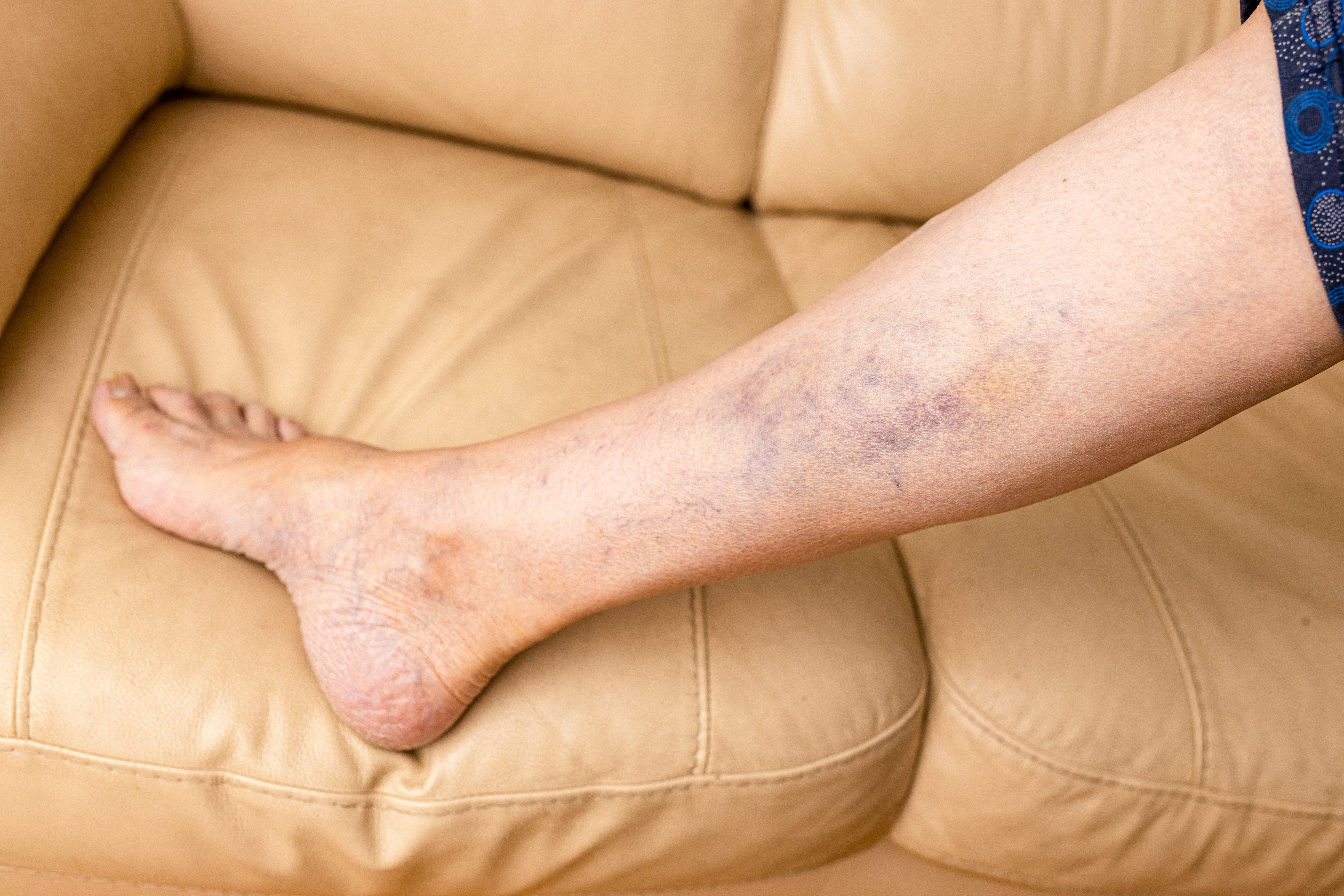 Blood Clots